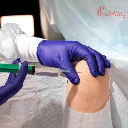 Stem Cell Therapy for Cartilage Regeneration in Mexico: A Cost-Effective Solution for Canadians